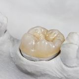 Dental Inlay, Onlay, Fillings, or Crowns Which is Best for You