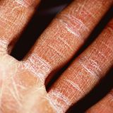 Es Salud: dermatopatías