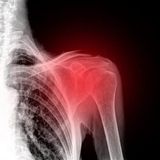 Terapia dell'artrite alla spalla con la tecnologia CEMP