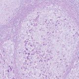 Rescue mutations protect liver from damage in patients with genetic disorder