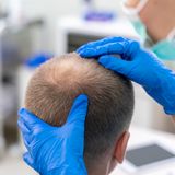 Your Scalp's Journey: What Really Happens During Stem Cell Hair Restoration
