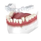 Invisalign Treatment Duration
