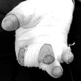 La piel de mariposa, la enfermedad rara que espera un medicamento decisivo en España