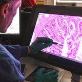 Earliest stages and possible new cause of stomach cancer revealed