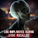 Los implantes alienígenas son reales