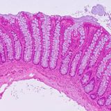 Childhood exposure to bacterial toxin may be triggering colorectal cancer epidemic among the young