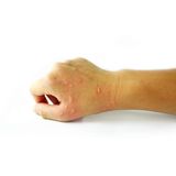 7 Allergie Rare di Cui Non Hai Mai Sentito Parlare