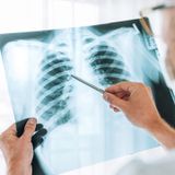 Origins of common lung cancer that affects smokers discovered