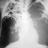 Survival Medicine Podcast: Tornadoes, Tuberculosis, Pregnancy Off The Gird, more