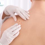 Why Choose SRT Therapy for Skin Cancer Treatment