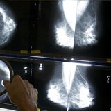 Bruce Ratner on Early Cancer Screening