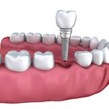 Dental Implants Types, Procedures, Benefits and More