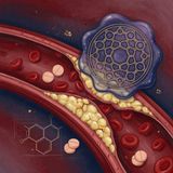 Statins & Cholesterol 2026: ApoB Targets and CAC Scan Advice