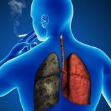 cáncer pulmonar