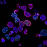 The Global Rise of Colorectal Cancer in Young Adults