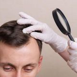 Las noticias de Herrero: Terapia con células madre: más cerca del fin de la alopecia