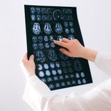 Il progetto Interceptor e la nuova era della diagnostica predittiva per la Malattia di Alzheimer