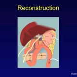 Managing Pancreatic Cancer: Surgery for Pancreatic Cancer, Its Complications, and the Importance of Surgical Volume (video)