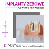 Dla marki D-DENT - Implanty - Co warto o nich wiedzieć?