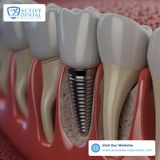 Dental Implants in Prosper