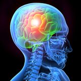 L'epoca nuova dell'emicrania