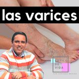 🤔QUÉ SON LAS VARICES? 🩸