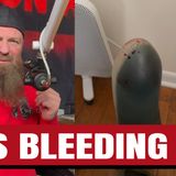 I Was BLEEDING Through My Prosthetic… Here’s What Keto Did to My Body