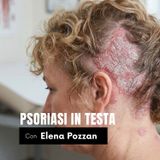 PSORIASI IN TESTA