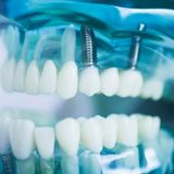 Impianti dentali senza dolore presso lo Studio Dentistico Minasi