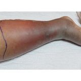 Survival Medicine Podcast: Cellulitis, Abscesses