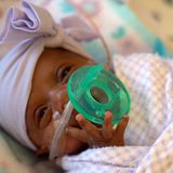 Size of an apple Girl becomes tiniest newborn to survive