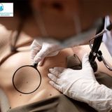 SRT Therapy: The Safe, Non-invasive Option for Skin Cancer Treatment