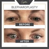 Signature - Eyelid Reduction (Blepharoplasty)