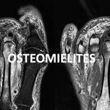 OSTEOMIELITES