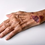 Dermatoporosi: Cause, Sintomi e Strategie per Prendersi Cura della Pelle Fragile