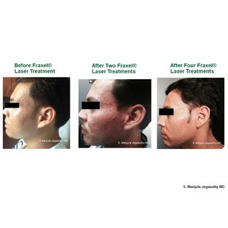 Health Check: The Latest Innovations for Managing Melasma, Erasing Acne Scars, and Body Contouring