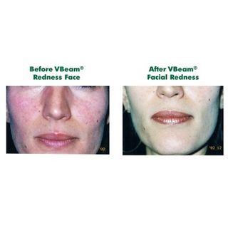 Health Check: How Treat Broken Facial Capillaries
