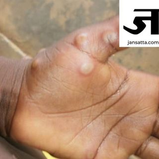 मंकीपाक्स का खतरा- Increasing Danger Of Monkeypox In India (26 July 2022)