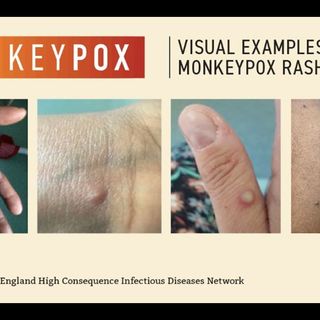 BREAKING:  Governor Newsom proclaims state of emergency to support state’s response to monkeypox