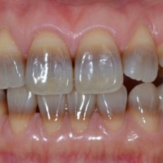 lo sbiancamento dei denti scurissimi