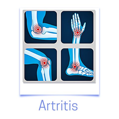 Episodio 5 - Artritis reumatoide