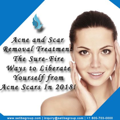 Acne and Scar Removal Treatment