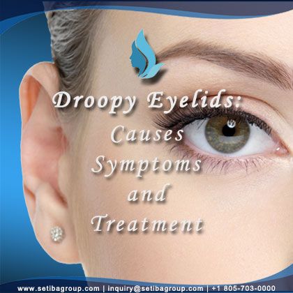 Droopy Eyelids Causes, Symptoms and Treatment