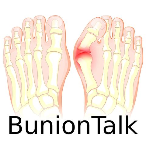 What You Need To Know About Bunions