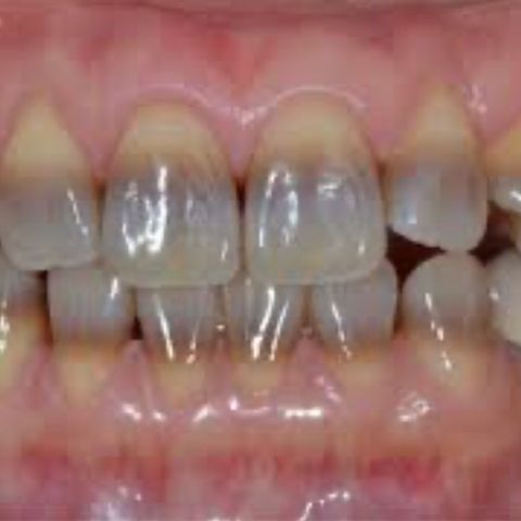 Alterazioni di colore dentale da antibiotici