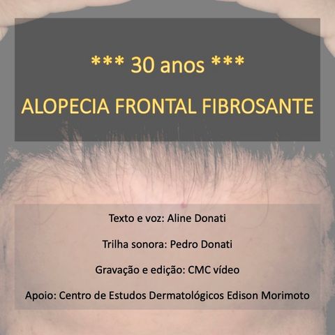Qual a causa da alopecia frontal fibrosante?