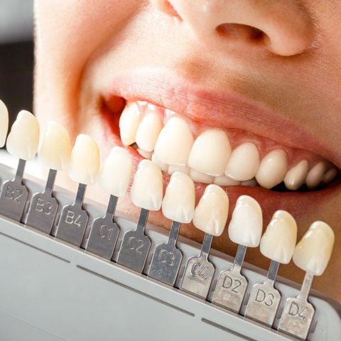 La soluzione estetica delle faccette dentali