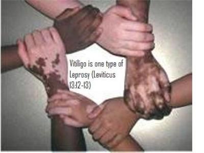 BIBLE LEPROSY-ORIGIN OF WHITE SKIN (Albinism & Vitiligo) PT2