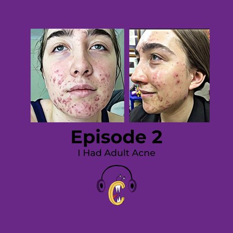 S1.E2: I Had Adult Acne