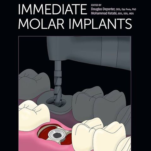 Immediate Molar Implants
